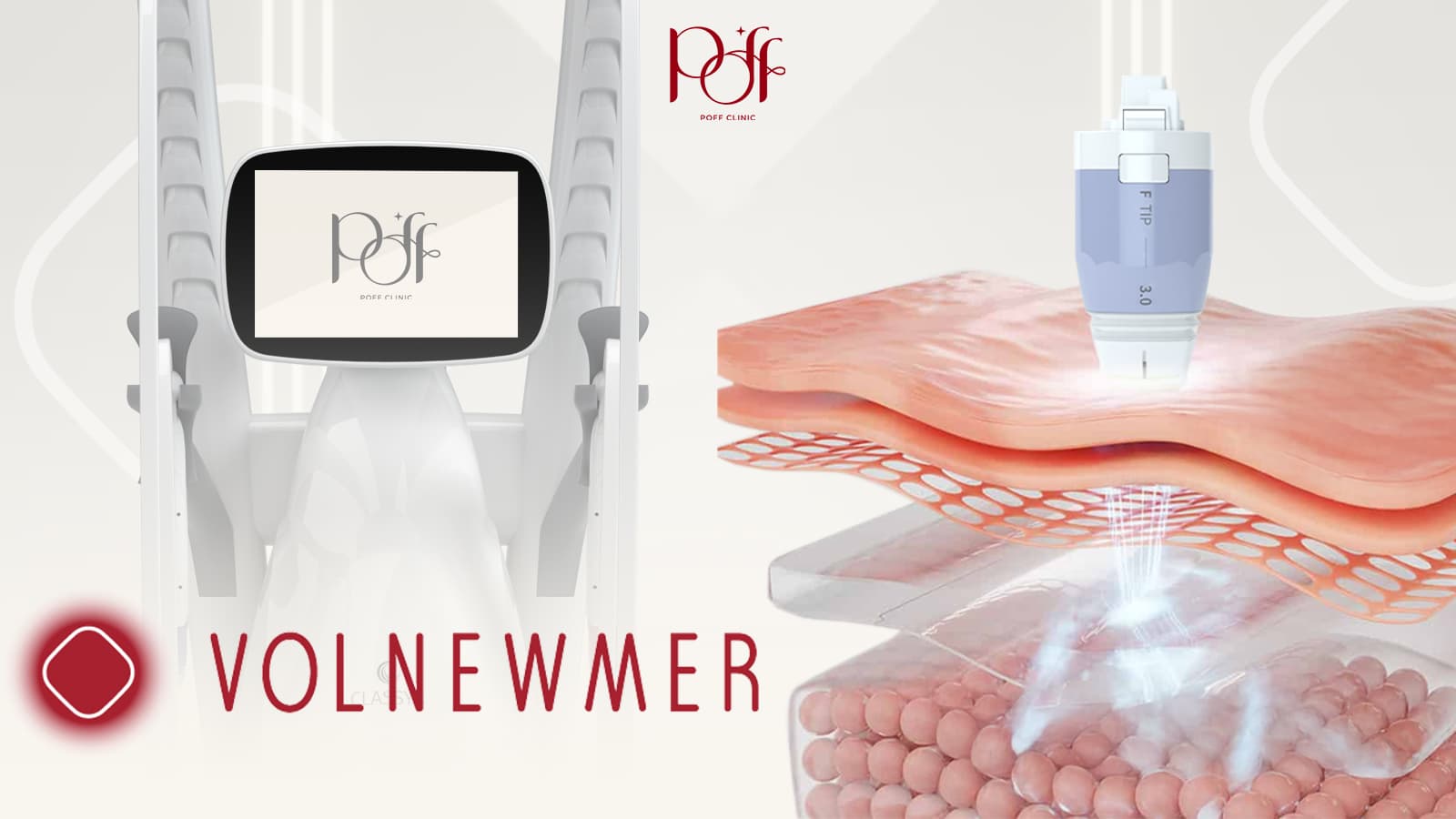 Volnewmer: มิติใหม่ของการยกกระชับด้วย Monopolar RF